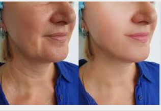 Endolift – Rejuvenecimiento facial y corporal sin cirugía